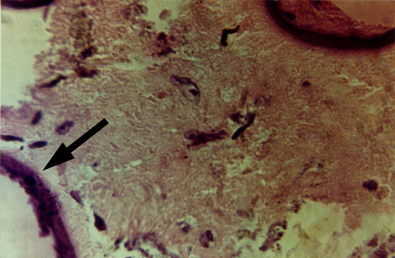 High magnification view of human primary breast tumor cells after 56 days of culture in a NASA Bioreactor. The arrow points to bead surface indicating breast cancer cells (as noted by the staining of tumor cell intermediate filaments). NASA's Marshall Space Flight Center (MSFC) is sponsoring research with Bioreactors, rotating wall vessels designed to grow tissue samples in space, to understand how breast cancer works. This ground-based work studies the growth and assembly of human mammary epithelial cell (HMEC) from breast cancer susceptible tissue. Radiation can make the cells cancerous, thus allowing better comparisons of healthy vs. tunorous tissue. Credit: Dr. Jearne Becker, University of South Florida