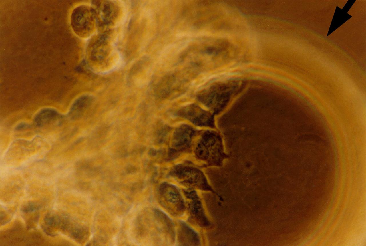 Human primary breast tumor cells after 49 days of growth in a NASA Bioreactor. Tumor cells aggregate on microcarrier beads (indicated by arrow). NASA's Marshall Space Flight Center (MSFC) is sponsoring research with Bioreactors, rotating wall vessels designed to grow tissue samples in space, to understand how breast cancer works. This ground-based work studies the growth and assembly of human mammary epithelial cell (HMEC) from breast cancer susceptible tissue. Radiation can make the cells cancerous, thus allowing better comparisons of healthy vs. tunorous tissue. Credit: Dr. Jearne Becker, University of South Florida