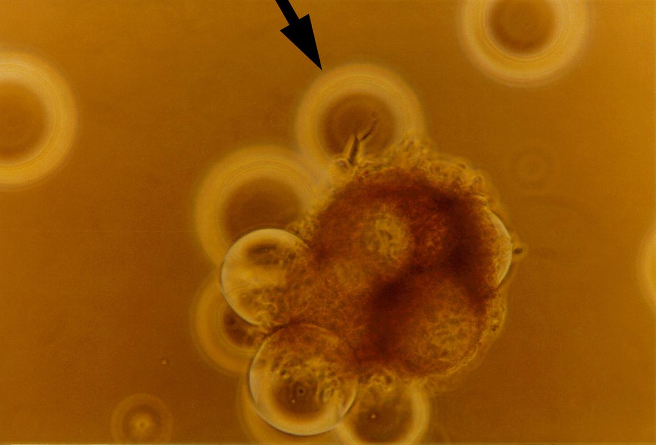 High magnification of view of tumor cells aggregate on microcarrier beads, illustrting breast cells with intercellular boundaires on bead surface and aggregates of cells achieving 3-deminstional growth outward from bead after 56 days of culture in a NASA Bioreactor. NASA's Marshall Space Flight Center (MSFC) is sponsoring research with Bioreactors, rotating wall vessels designed to grow tissue samples in space, to understand how breast cancer works. This ground-based work studies the growth and assembly of human mammary epithelial cell (HMEC) from breast cancer susceptible tissue. Radiation can make the cells cancerous, thus allowing better comparisons of healthy vs. tunorous tissue. Credit: Dr. Jearne Becker, University of South Florida.