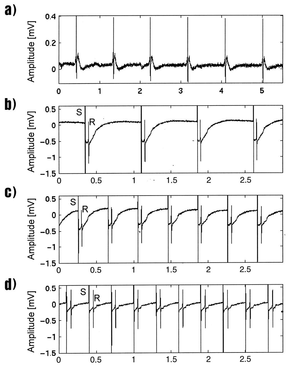 Lisa Freed and Gordana Vunjak-Novakovic, both of the Massachusetts Institute of Technology (MIT), have taken the first steps toward engineering heart muscle tissue that could one day be used to patch damaged human hearts. Cells isolated from very young animals are attached to a three-dimensional polymer scaffold, then placed in a NASA bioreactor. The cells do not divide, but after about a week start to cornect to form a functional piece of tissue. Functionally connected heart cells that are capable of transmitting electrical signals are the goal for Freed and Vunjak-Novakovic. Electrophysiological recordings of engineered tissue show spontaneous contractions at a rate of 70 beats per minute (a), and paced contractions at rates of 80, 150, and 200 beats per minute respectively (b, c, and d). The NASA Bioreactor provides a low turbulence culture environment which promotes the formation of large, three-dimensional cell clusters. The Bioreactor is rotated to provide gentle mixing of fresh and spent nutrient without inducing shear forces that would damage the cells. Due to their high level of cellular organization and specialization, samples constructed in the bioreactor more closely resemble the original tumor or tissue found in the body. NASA-sponsored bioreactor research has been instrumental in helping scientists to better understand normal and cancerous tissue development. In cooperation with the medical community, the bioreactor design is being used to prepare better models of human colon, prostate, breast and ovarian tumors. Cartilage, bone marrow, heart muscle, skeletal muscle, pancreatic islet cells, liver and kidney are just a few of the normal tissues being cultured in rotating bioreactors by investigators. The work is sponsored by NASA's Office of Biological and Physical Research. The bioreactor is managed by the Biotechnology Cell Science Program at NASA's Johnson Space Center (JSC). Credit: NASA and MIT.