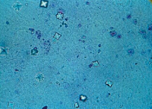 Renal stones are never convenient, but they are a particular concern for astronauts who have limited access to treatment during flight. Researchers are examining how earthbound preventions for renal stone formation work in flight, ensuring missions are not ended prematurely due to this medical condition. The micrograph shows calcium oxalate crystals in urine. These small crystals can develop to form renal stones. Principal Investigator: Dr. Peggy Whitson, NASA Johnson Space Center, Houston, TX.