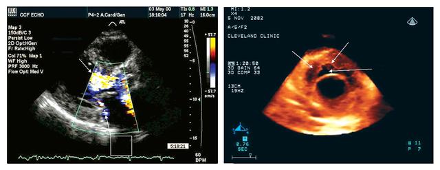 Echocardiography uses sound waves to image the heart and other organs.  Developing a compact version of the latest technology improved the ease of monitoring crew member health, a critical task during long space flights.  NASA researchers plan to adapt the three-dimensional (3-D) echocardiogram for space flight.  The two-dimensional (2-D) echocardiogram utilized in orbit on the International Space Station (ISS) was effective, but difficult to use with precision.  A heart image from a 2-D echocardiogram (left) is of a better quality than that from a 3-D device (right), but the 3-D imaging procedure is more user-friendly. 