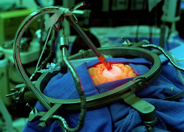 What started out as an attempt to develop a light which would allow for the growth of plants in space led to a remarkable discovery: The Light Emitting Diode (LED). This device through extensive study and experimentation has developed into a tool used by surgeons in the fight against brain cancer in children. Pictured is a mock-up of brain surgery being performed. By encapsulating the end of the LED with a balloon, light is diffused over a larger area of the brain allowing the surgeon a better view. This is one of many programs that begin as research for the space program, and through extensive study end up benefitting all of mankind.