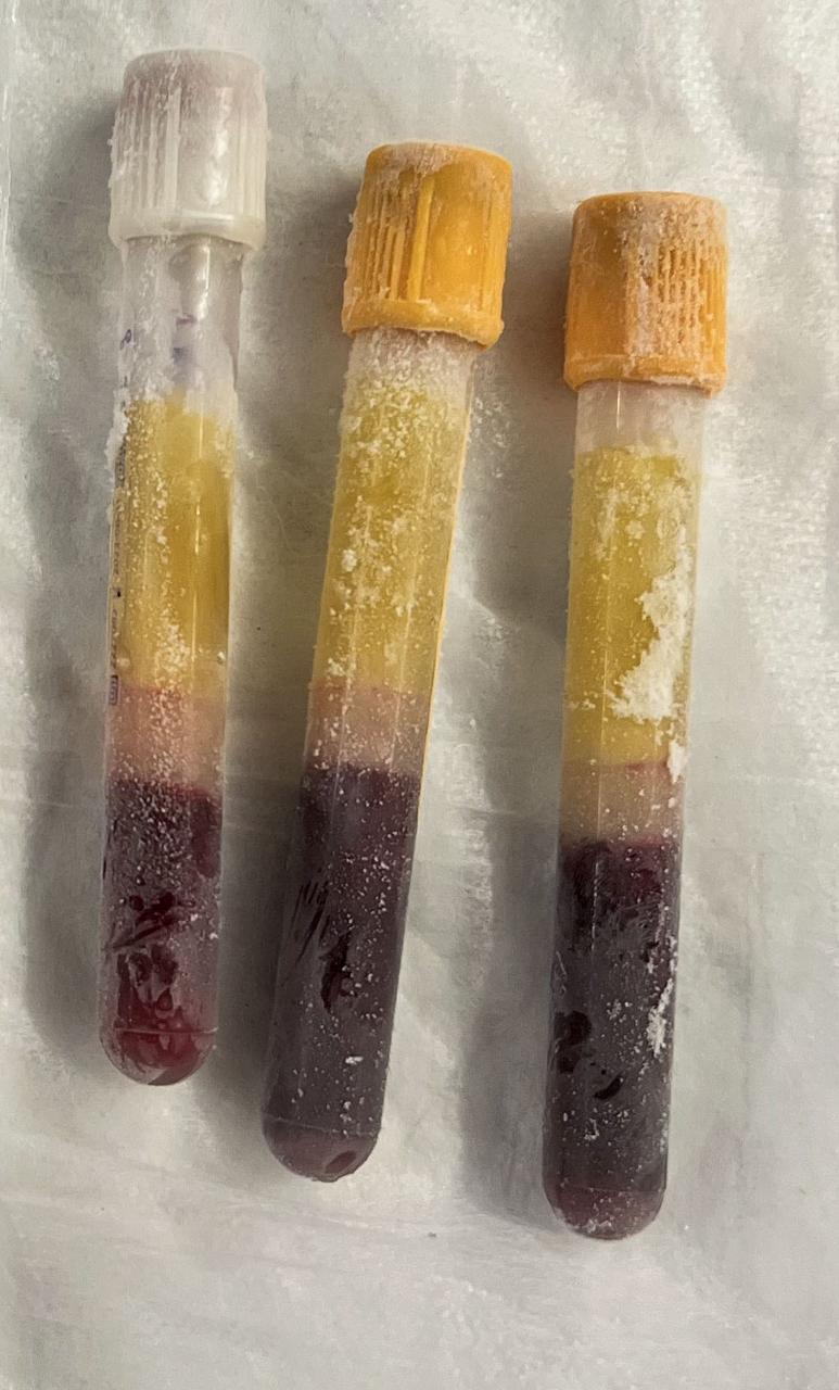jsc2024e050837 (7/26/2024) --- Frozen blood samples collected aboard the International Space Station after return to Earth are part of the B Complex: A Nutraceutical SANS Countermeasure (B Complex) investigation. This study tests whether a daily B vitamin supplement can prevent or mitigate SANS and also assesses how an individual’s genetics may influence the response. The results could help maintain astronaut vision and health on future long-duration missions, including those to Mars.