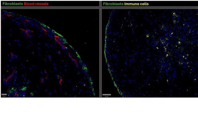 jsc2024e071691 (11/5/2024) --- Immunofluorescence staining of a synovial organoid shows CD68+ macrophages (immune cells) in yellow, CD31+ endothelial cells (blood vessels) in red, PDPN+ fibroblasts in green, and nuclei in blue is seen. This image was taken on a confocal microscope and is part of the ICE Cubes #9.4 – Aging in Microgravity investigation. Image courtesy of University of Oxford.